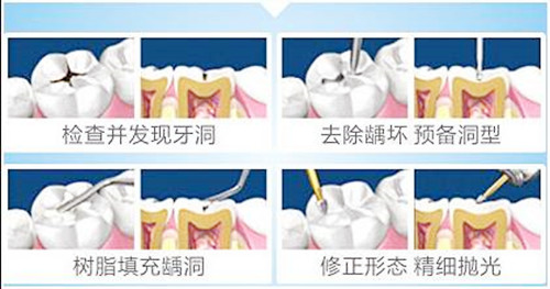 3m树脂补牙流程