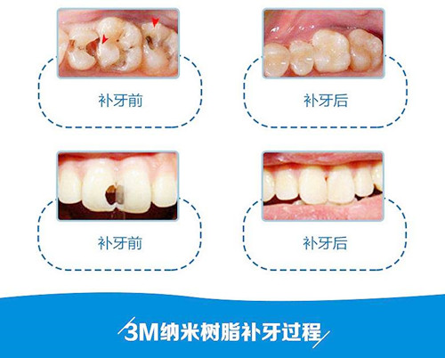 3m树脂补牙逼真