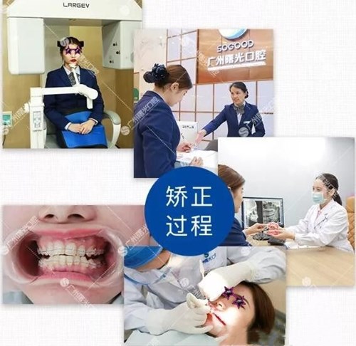 广州曙光牙齿矫正过程