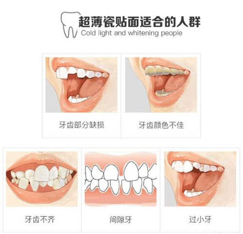 广州哪个医生做牙齿瓷贴面效果好