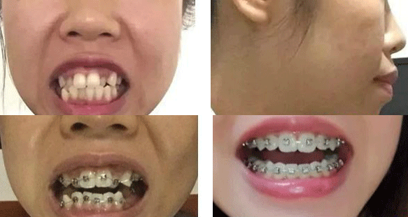 汕头华美口腔凸嘴进行牙齿正畸前后案例对比.png