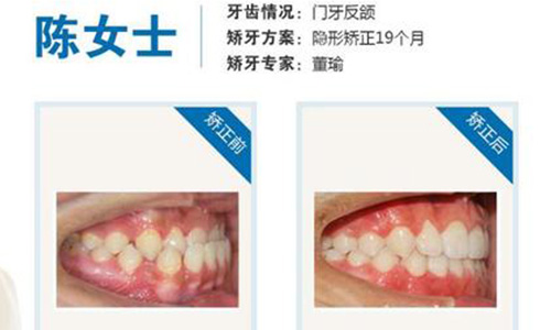 南宁有口碑好的正规口腔医院吗?牙齿矫正种植牙价格看这家!