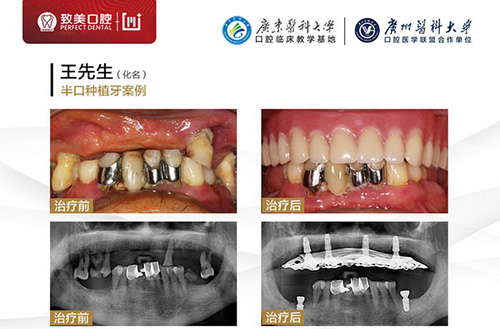 惠州种牙要多少钱一颗 这家医院种植牙齿价格便宜又好