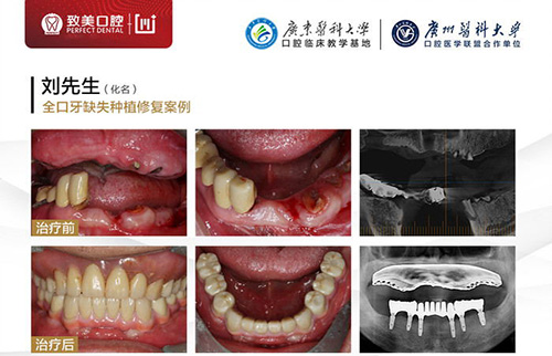 惠州种牙要多少钱一颗 这家医院种植牙齿价格便宜又好