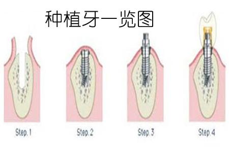 种植牙手术过程步骤