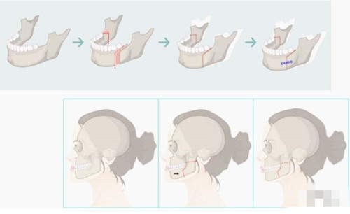 牙齿矫正可以改变脸型吗？