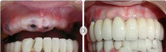 汕头芽芽口腔牙齿种植前后案例对比