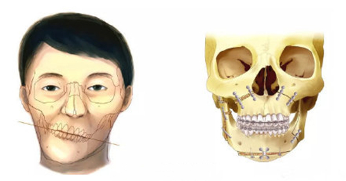 颌骨畸形患者手绘矫正对比图
