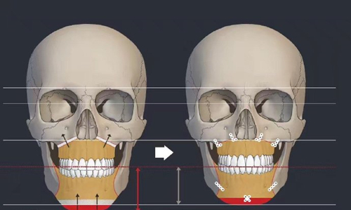 正颌手术CT前后对比