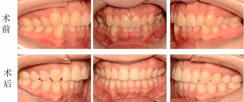 长沙美奥口腔矫正案例