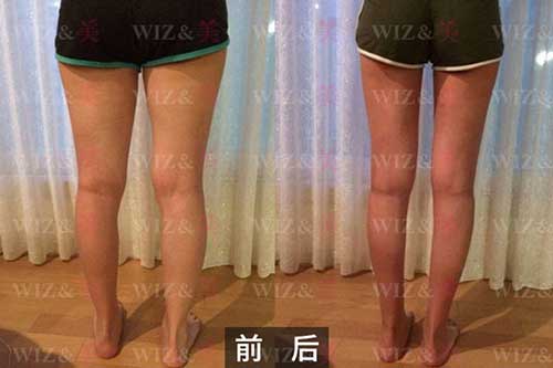 韩国WIZ美腿部吸脂