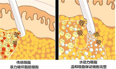 丹东抽脂减肥哪里好?抽脂手术多少钱能抽腰腹跟面部吗？