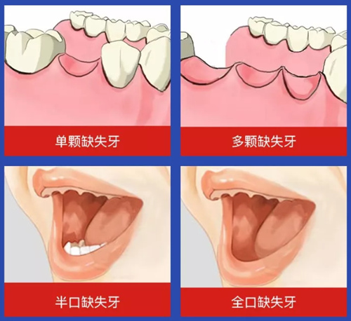 牙齿缺失的四种情况