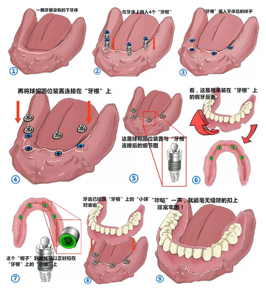 全口种植牙种植示意图