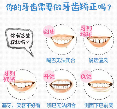 哪些情況下需要做牙齒矯正