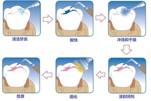 窝沟封闭什么时候做合适,宁波鄞州壹加壹口腔咋样价格多少