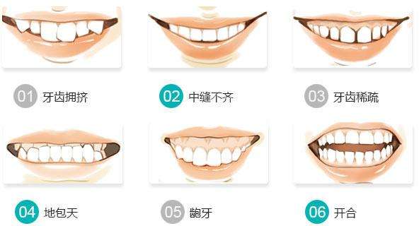 牙齿矫正类型