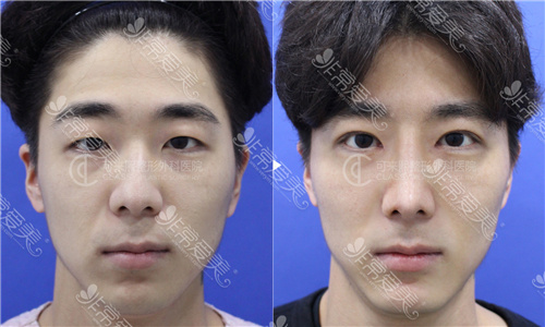 韩国可来熙整形医院男生眼鼻综合案例