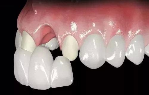 牙齿断裂可以用烤瓷牙进行修复