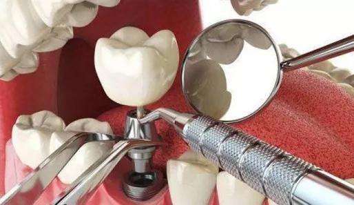 没有牙根也是可以做种植牙手术的