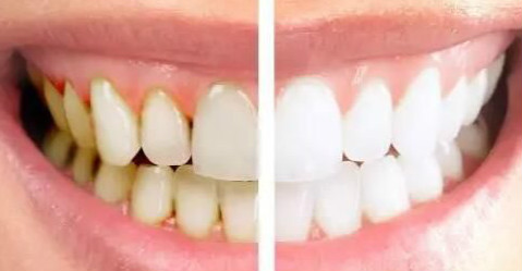 柯子豪医生牙齿美白修复案例对比