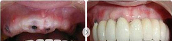 刘丹医生种植牙案例对比