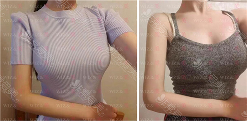 韩国wiz美整形医院手臂吸脂术后六个月效果图