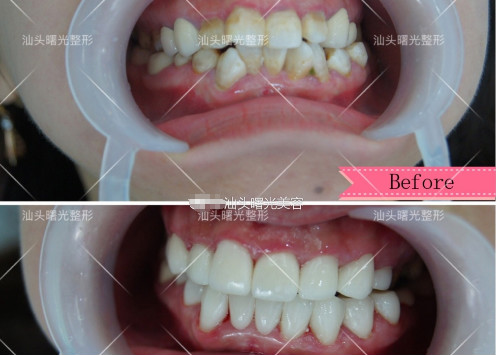 庞观养医生3d仿生美容冠牙齿矫正案例对比