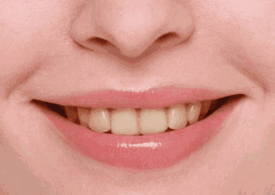 牙齿泛黄笑容减分