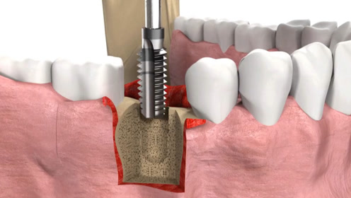 种植体是要植入到牙槽骨里面