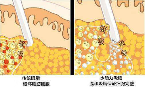 传统吸脂和水动力吸脂对比