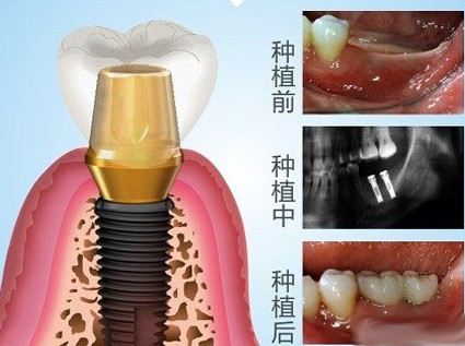 种植牙术前术中术后过程