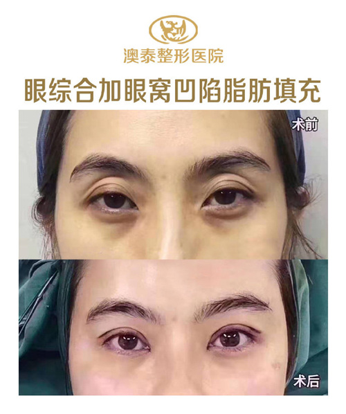 湛江澳泰整形医院眼综合 眼窝凹陷填充前后对比照片