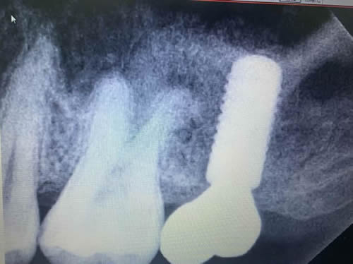 种植牙CT图片展示