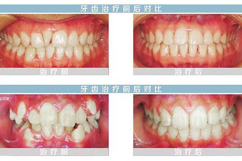 杭州美奥口腔医院舌侧矫正对比图