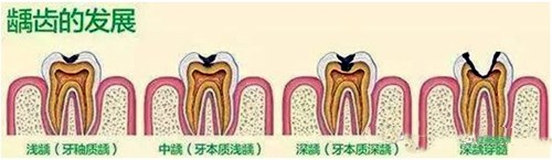 牙齿上有小黑点是怎么回事？2分钟告诉你如何清理！