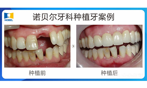 西安诺贝尔口腔诺贝尔种植牙加爱尔创全瓷牙管只100元 非常爱美