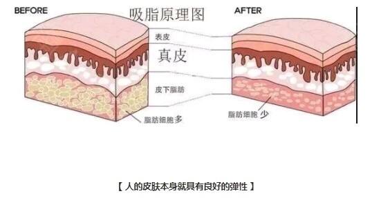 吸脂手術(shù)原理