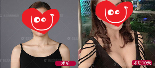 南京有专门的隆胸医院吗?华美vs美莱,内窥镜隆胸哪家更擅长