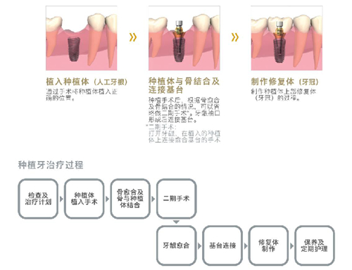 种植牙三期戴牙流程图片