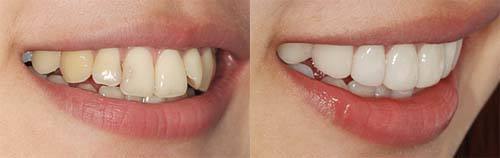 全瓷牙术前术后案例对比