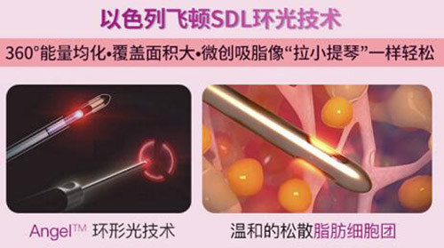 5G天使光雕吸脂怎么样 5G天使光雕吸脂怎么样
