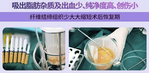 5G天使光雕吸脂好不好 5G天使光雕吸脂好不好