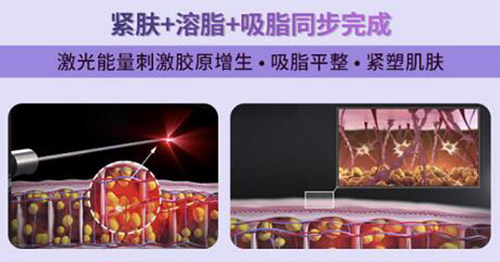 5G天使光雕吸脂怎么样 5G天使光雕吸脂怎么样