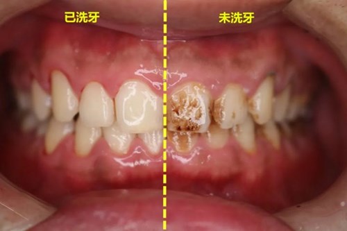 洗牙前和洗牙后的对比