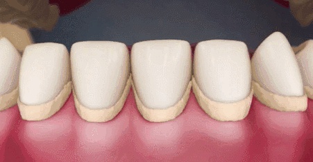 牙齿上厚厚的牙结石