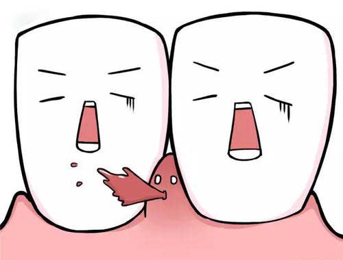 洗牙和牙周病