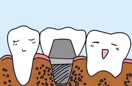 种植牙有哪些常见问题