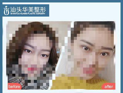 汕頭華美整形朱洙玉醫(yī)生綜合媚眼術(shù)案例對比