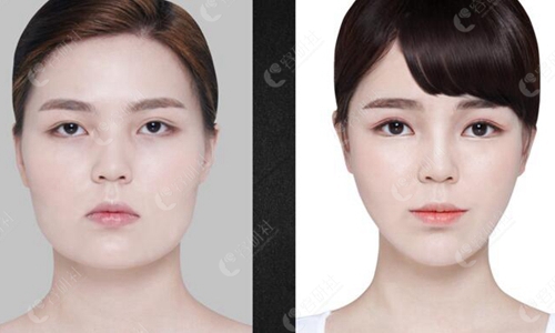 在韩国必当归做下颌角整形术前术后对比